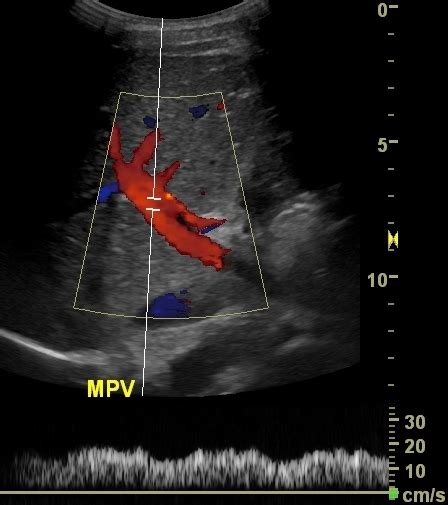 Complies with house-wide BSI precautions and follows recommendations for cleaning transducers. . St elizabeth ultrasound
